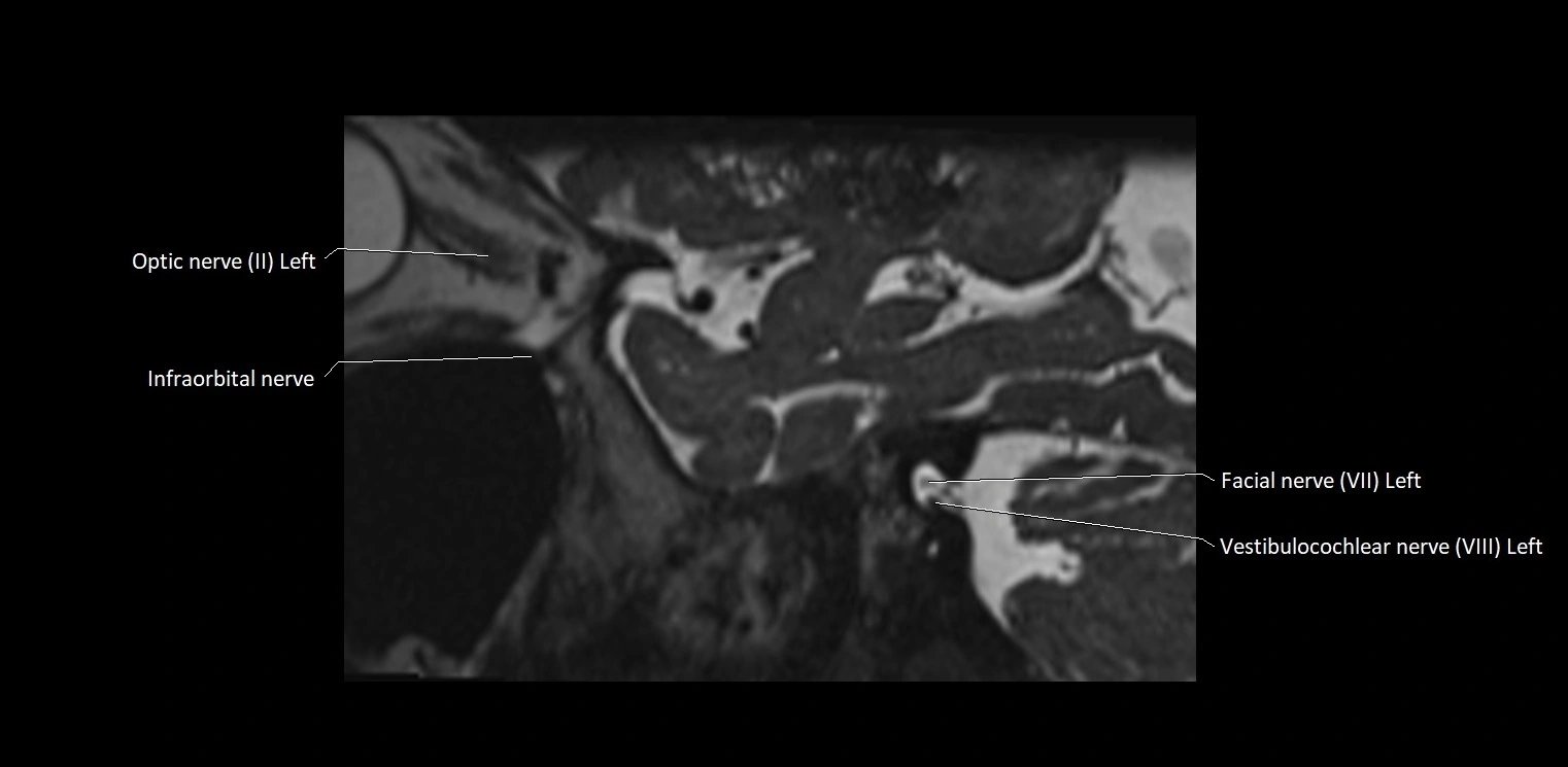 Cranial nerve sagittal anatomy MRI 3T image 13.webp
